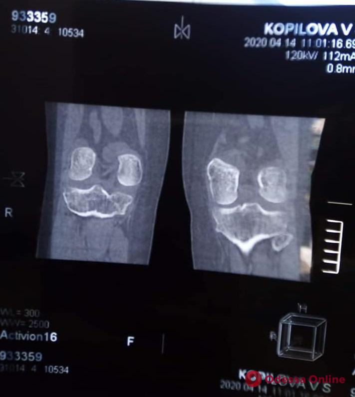 Опухоль кости: жительница Великодолинского нуждается в срочной помощи