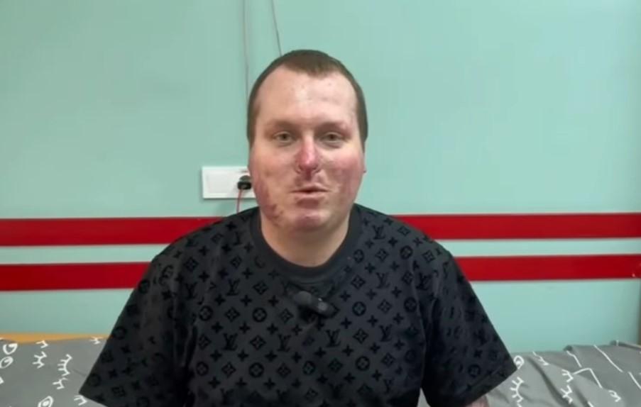 В одесской больнице благодаря инновационному оборудованию спасли полицейского, который из-за атаки РФ получил 85% ожогов тела В одесской больнице благодаря инновационному оборудованию спасли полицейского, который из-за атаки РФ получил 85% ожогов тела