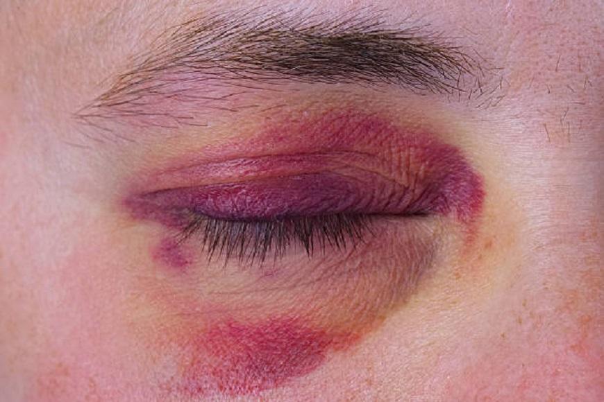 Синці по всьому тілу: нетверезий житель Одещини побив дружину