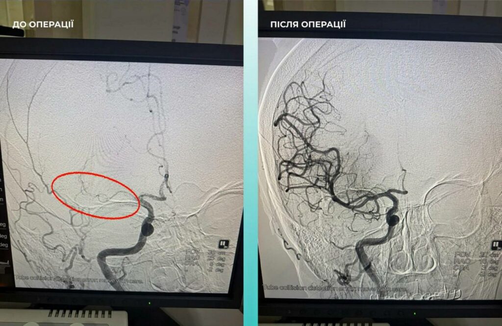 Врятоване життя: одеські медики провели унікальну подвійну операцію