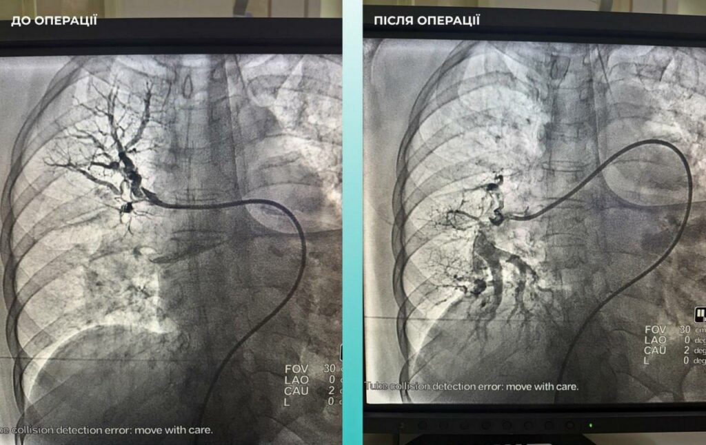 Врятоване життя: одеські медики провели унікальну подвійну операцію
