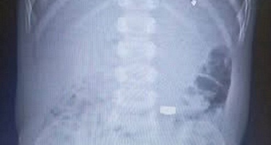 В Одесі лікарі врятували трирічну дитину, яка проковтнула батарейку В Одесі лікарі врятували трирічну дитину, яка проковтнула батарейку